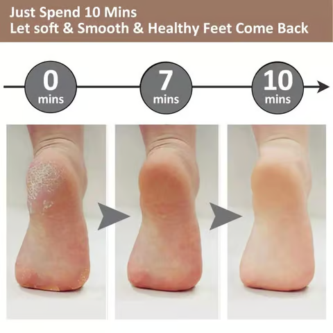 Electric Foot Callus Remover – Smooth and Soft Feet at Home