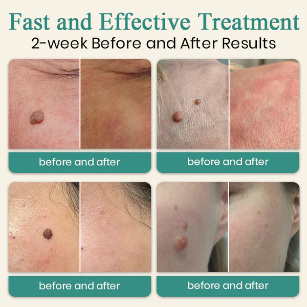 Precision Skin Perfection Laser Pen