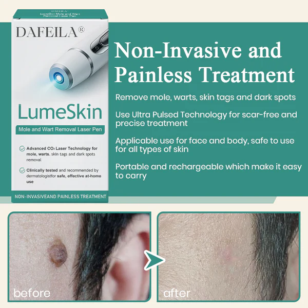 Precision Skin Perfection Laser Pen