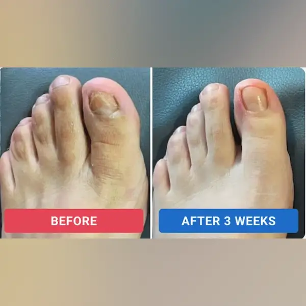 Powerful Fungal Nail Renewal Patches